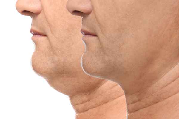 HIFU - Breakthrough in Anti - ageing 2 hifu results Bury St Edmunds