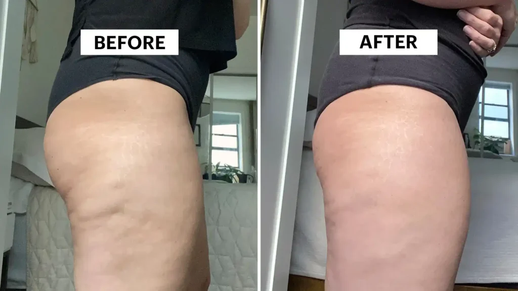 Do Toning Exercise Bury St Edmunds Really Tackle Cellulite?