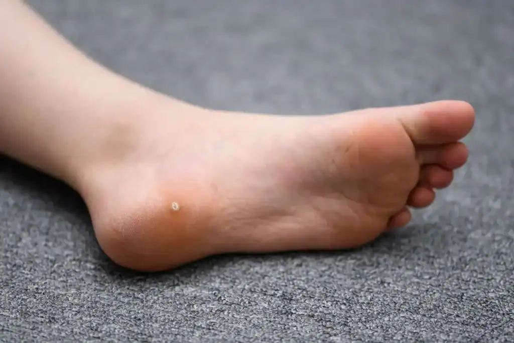 Cryotherapy For Warts And Also Verrucas 2 Image of verruca on the bottom of the foot that able to be treated with Cryotherapy Bury St Edmunds