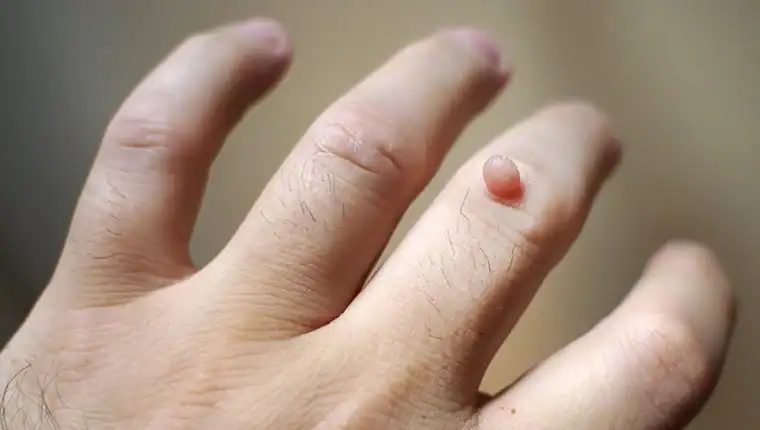 Cryotherapy For Warts And Also Verrucas 1 Image of blemish that Cryotherapy Bury St Edmunds can remove with Lipo 360.