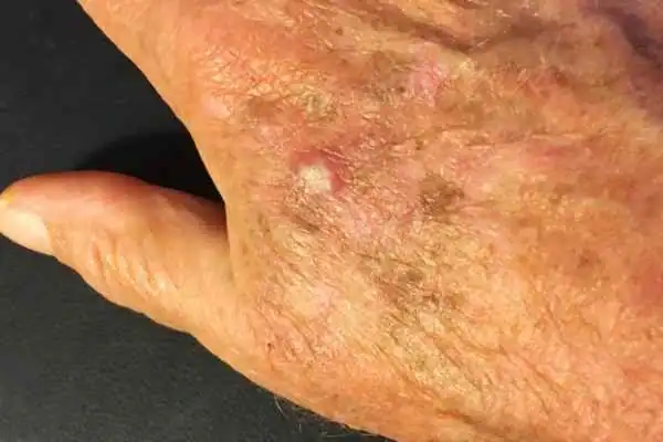 Cryopen For Actinic Keratoses 1 Image of Actinic keratoses Bury St Edmunds on a person hand