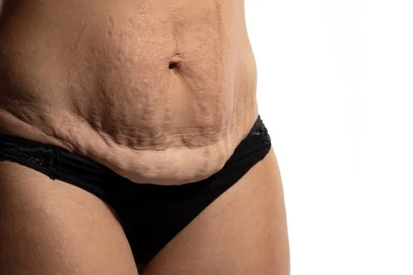 The science behind skin tightening Bury St Edmunds picture of a woman's sagging skin on the stomach